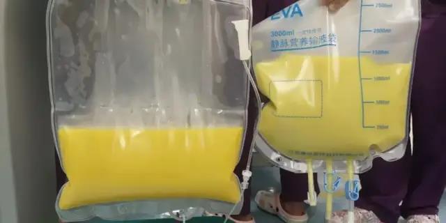 甘油三酯超正常值近百倍！血浆脂肪样！小伙患上的这类疾病很凶险！