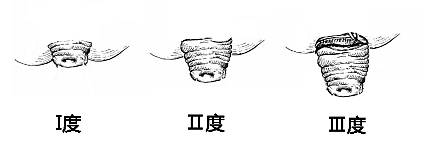 排便时掉出“小尾巴”？未必是痔疮