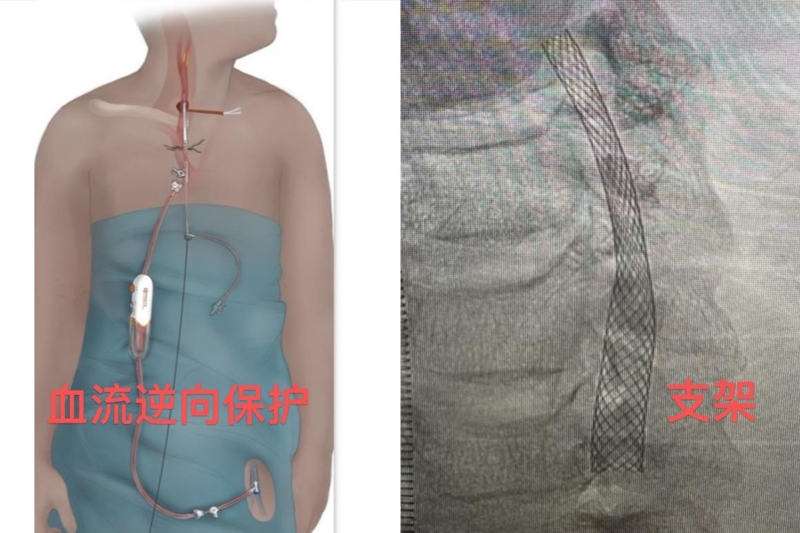 发现颈动脉狭窄，手术有必要吗？